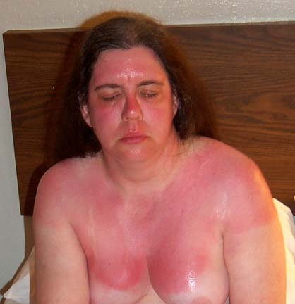 Ida Rediscovers that Sunscreen is a GOOD Thing!